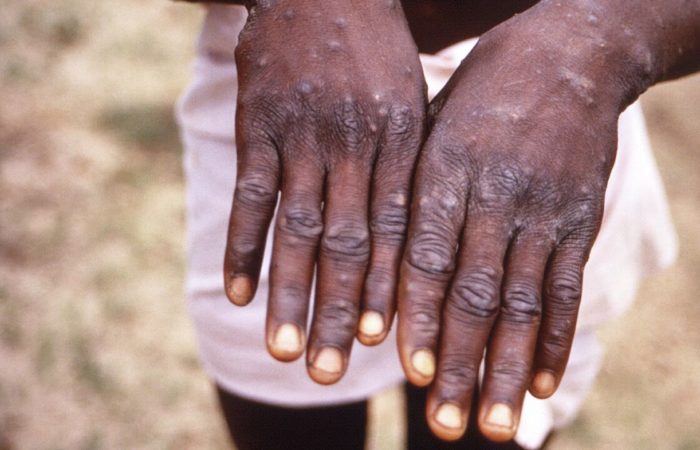 The first monkeypox vaccine has been prequalified.