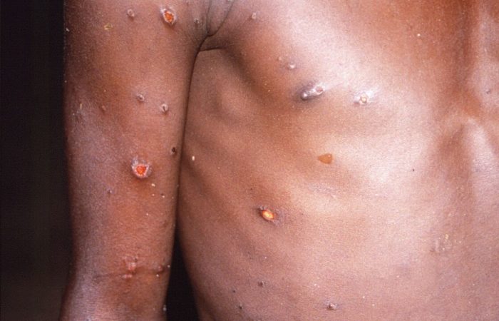 The United States has reported its first case of infection with a severe strain of monkeypox.